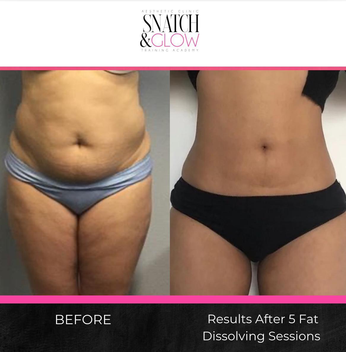 The Truth About Fat Dissolving Injections Do They Really Work ?