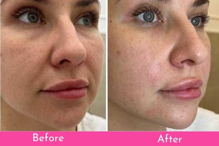 PDO Threads: The Non-Surgical Facelift That Actually Works 👀